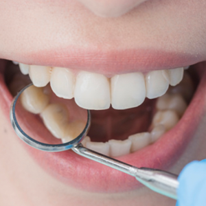 O que são dentes do siso e como são extraídos?