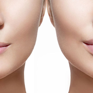 Preenchimento labial: entenda como funciona o procedimento